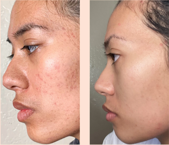 Before and after image showing skin improvement with hydroquinone skin bleaching cream Expigment usage.
