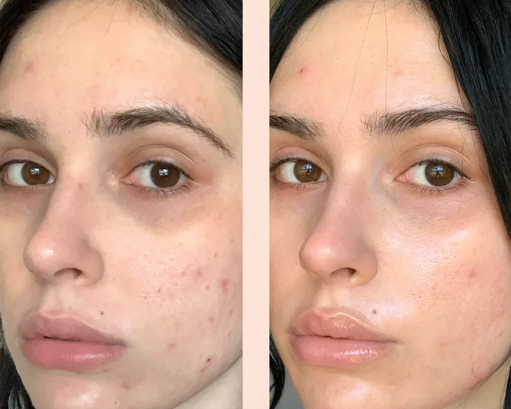 Before and after using hydroquinone skin bleaching cream Expigment for acne scar treatment.
