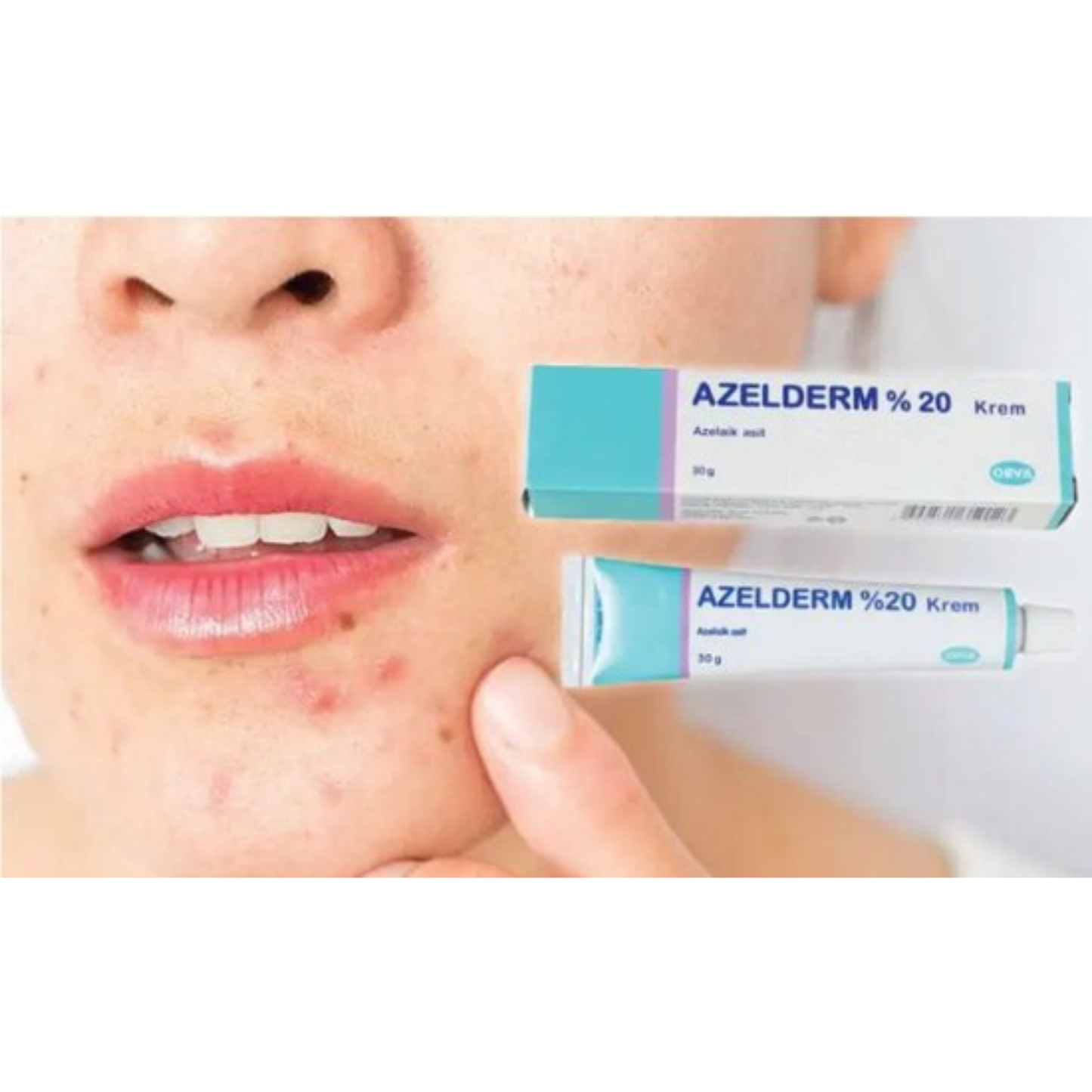 AZELDERM 0.2% 30g Acne Cream – Effective Acne and Spot Remover