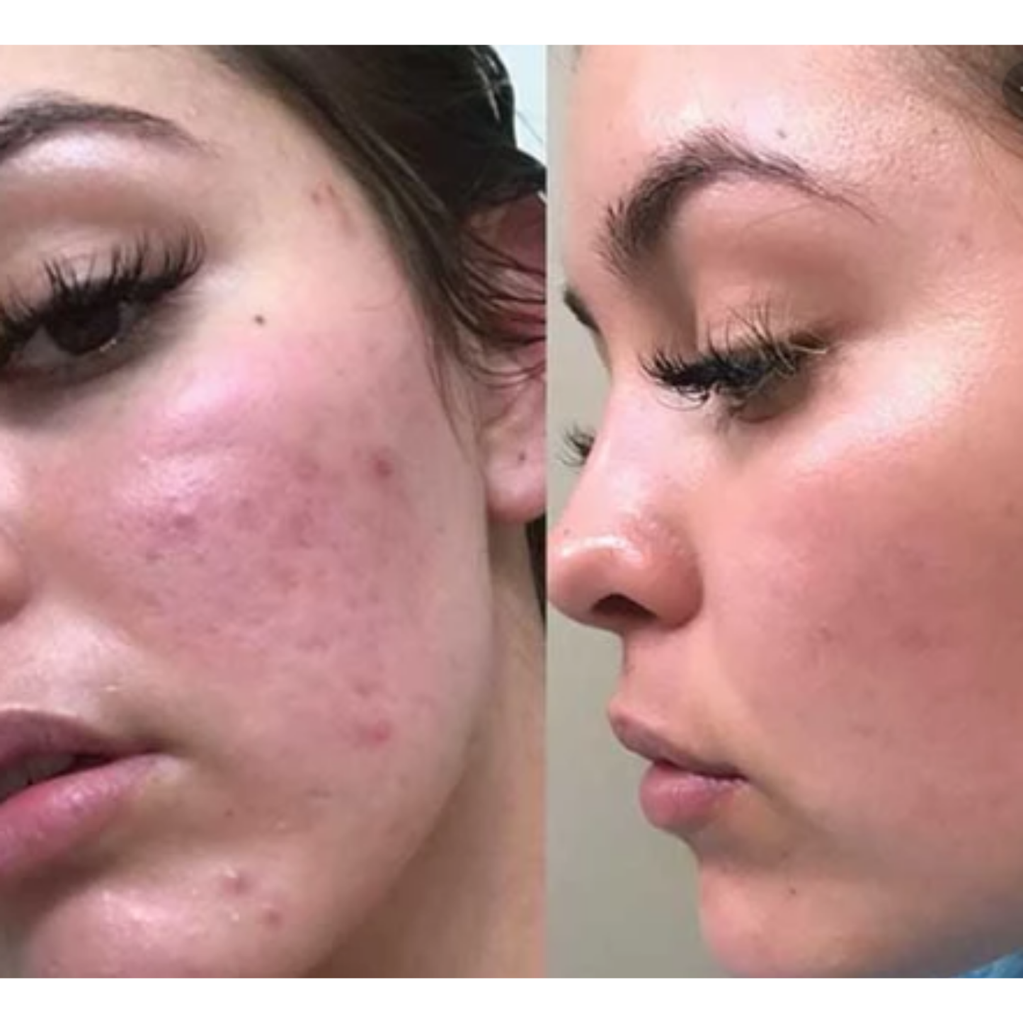 AZELDERM 0.2% 30g Acne Cream – Effective Acne and Spot Remover