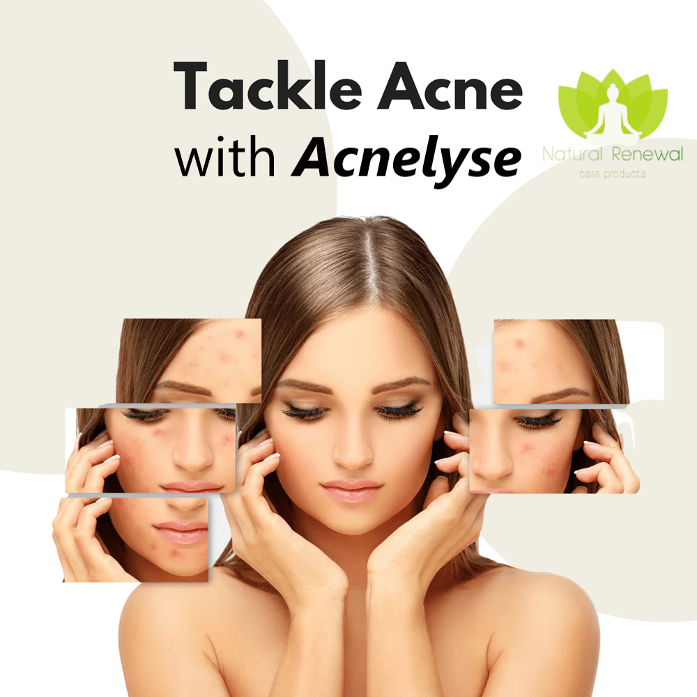 tackle acne with acnelyse