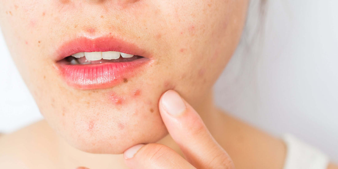 How to get rid of deep pimples?